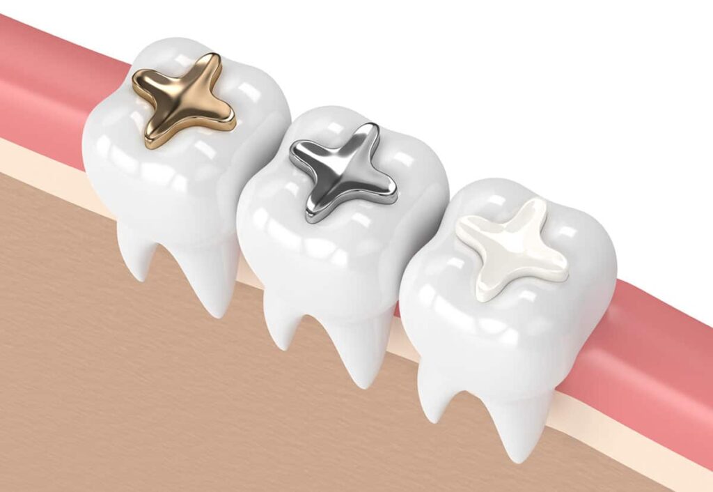 Types of Dental Filling