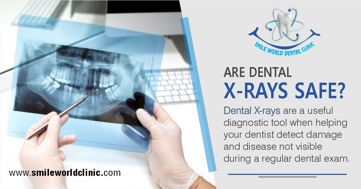 Are Dental x-rays safe
